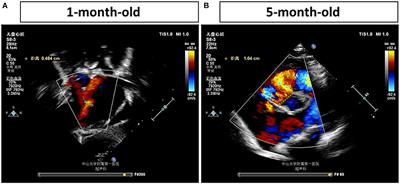 A Chromosomal Inversion of 46XX, inv (6) (p21.3p23) Connects to Congenital Heart Defects